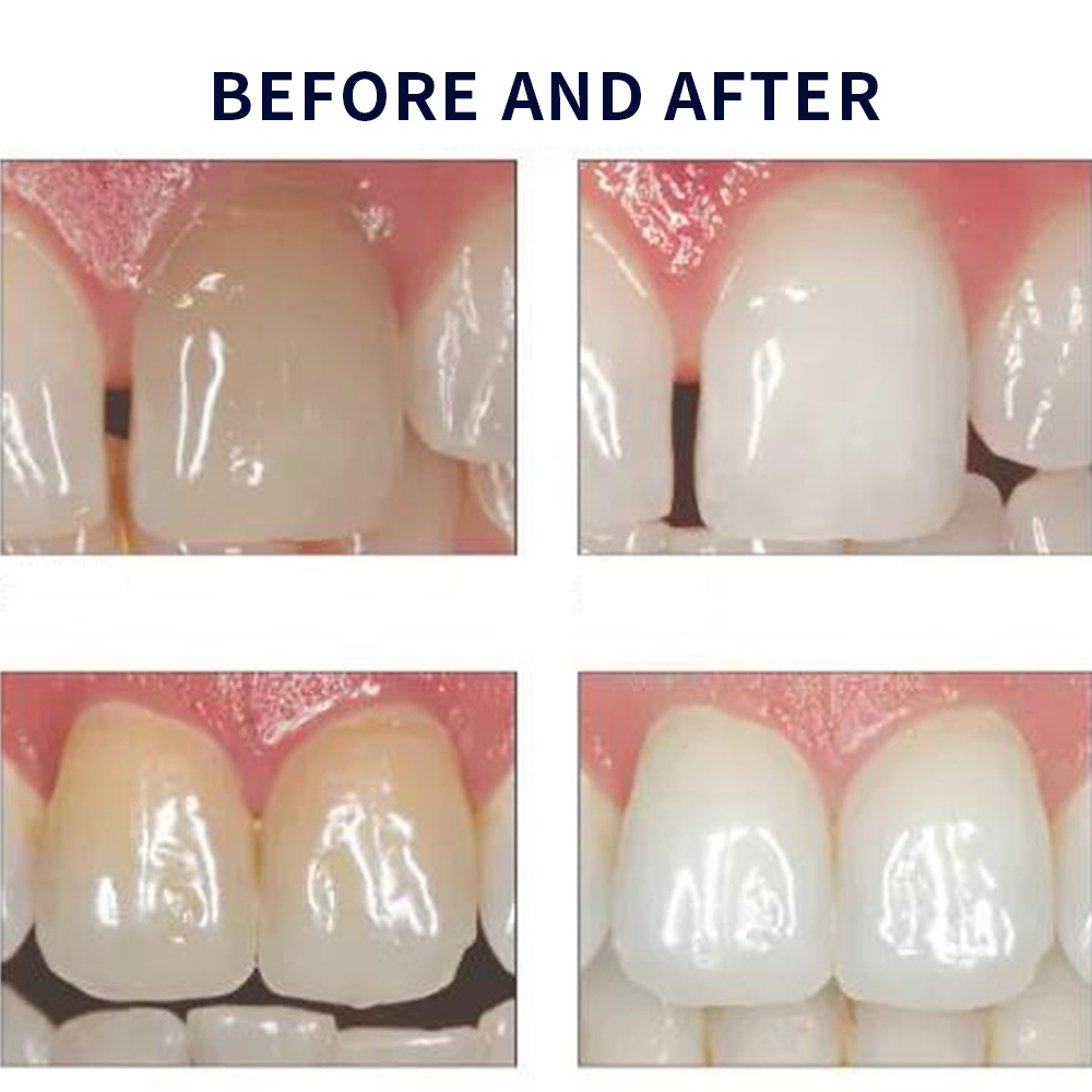 Opalescence Whitening 20% PF 2 - Teeth Whitening Flash review and price