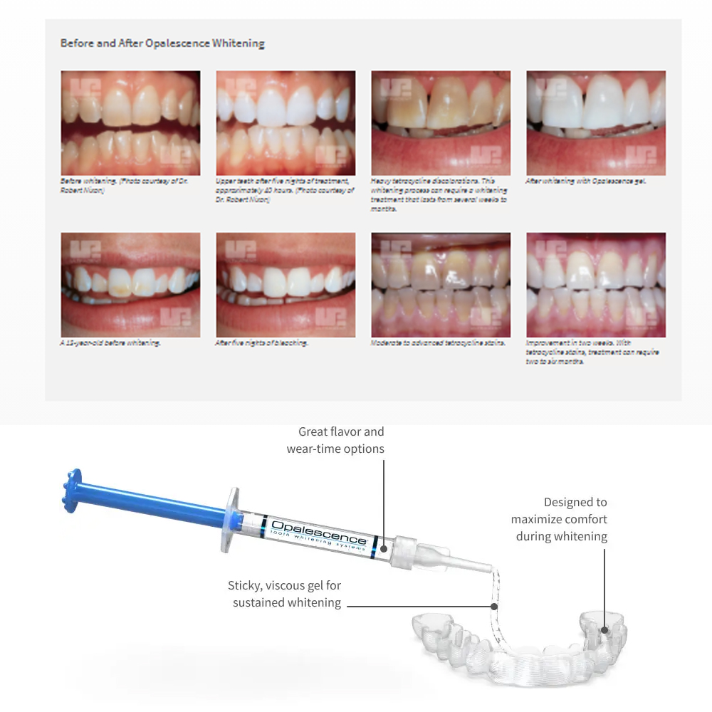 Opalescence Whitening 20% PF 2 - Teeth Whitening Flash review and price