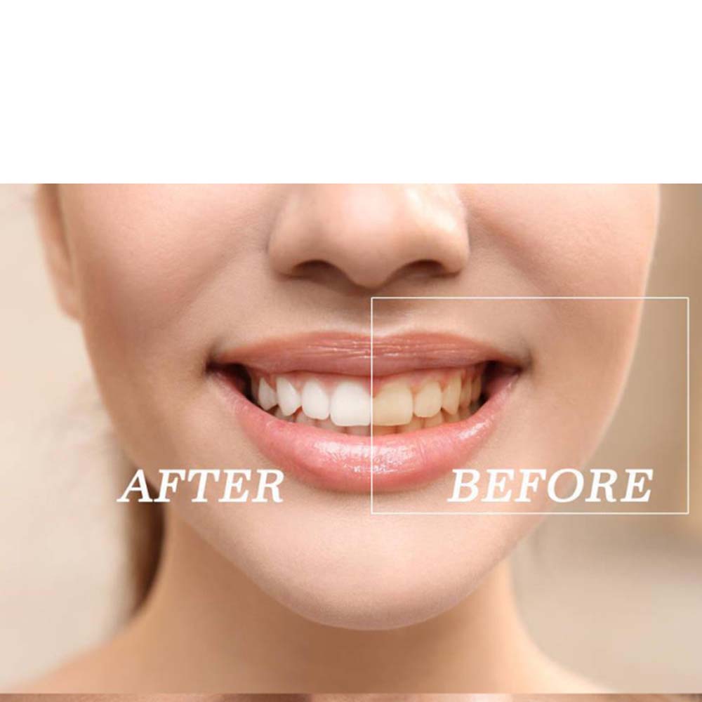 Top Quality Peroxide Teeth Whi - Teeth Whitening (Bleaching) review and price