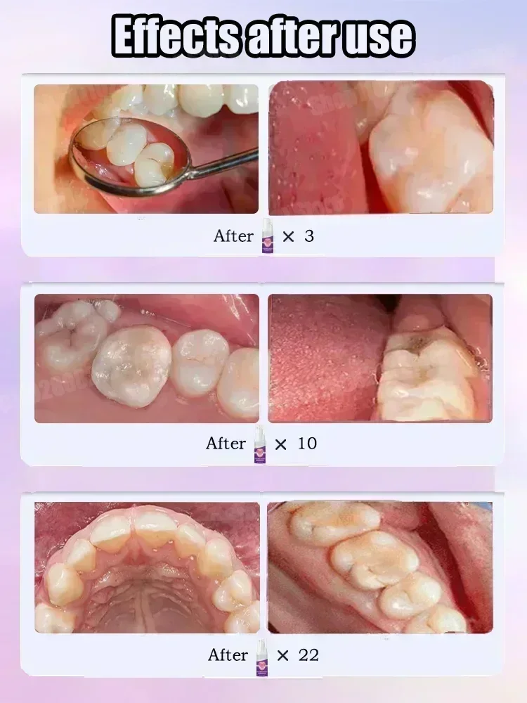 Teeth Cleaning Toothpaste Remo - Teeth Whitening Treatment review and price